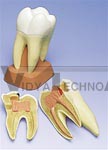 Upper Triple-Root Molar with Caries, 2 part